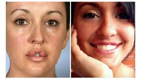 Catherine Reitman Lips Surgery: Before and After Images